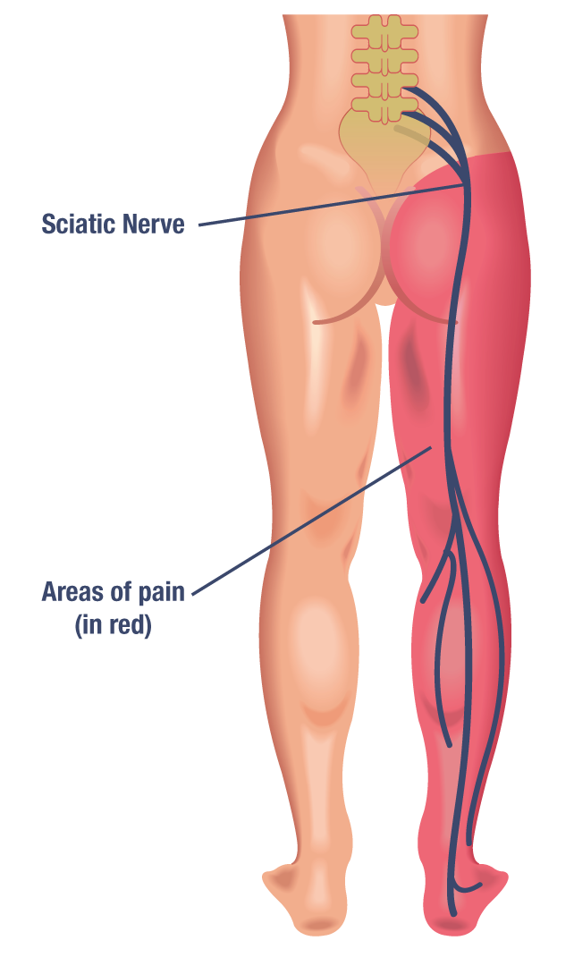 Relieve Buttock Muscle Pain